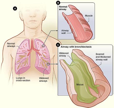 Bronchiectasis diagram