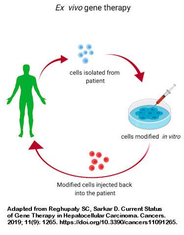 A graphical illustration of ex vivo gene therapy.