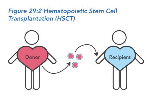 Illustration of Hematopoietic stem cell transplantation.