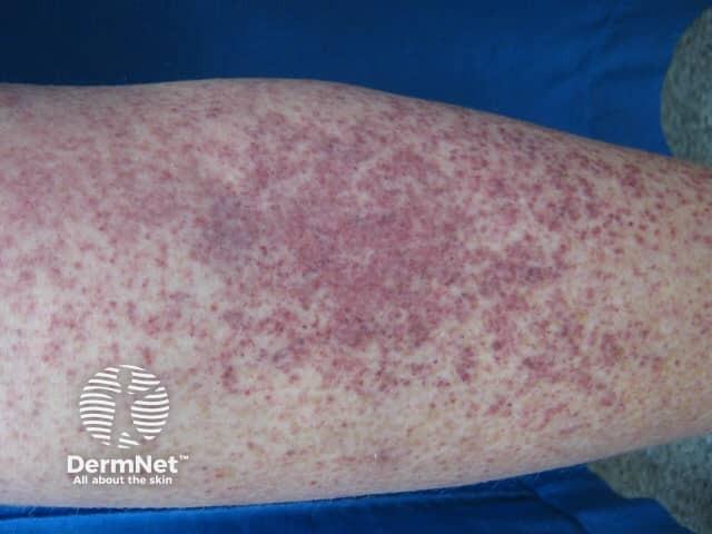 arm with skin rash
